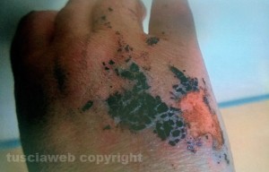 La mano della donna, sfregiata con una sostanza corrosiva