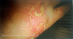 La mano della donna, sfregiata con una sostanza corrosiva