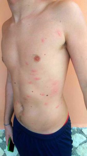 Ronciglione - Il ragazzo finito al pronto soccorso con lo sfogo sulla pelle 