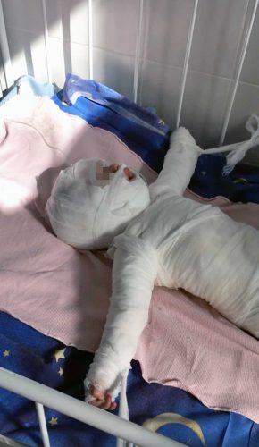 Odessa - Bimba di 11 mesi ustionata
