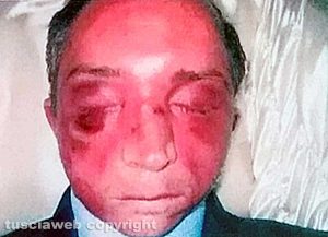 Viterbo - Omicidio del Suffragio - Daniele Barchi col volto tumefatto