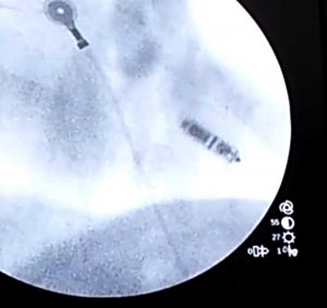 Il pacemaker senza fili