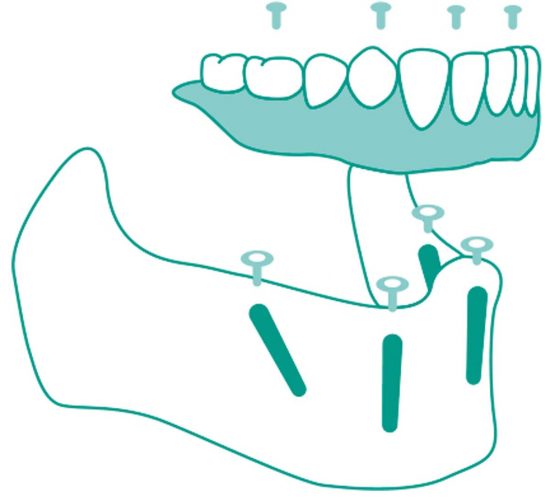 Implantologia a carico immediato