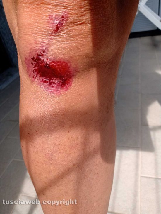 Ferita di un lettore causata dalla caduta su sampietrini