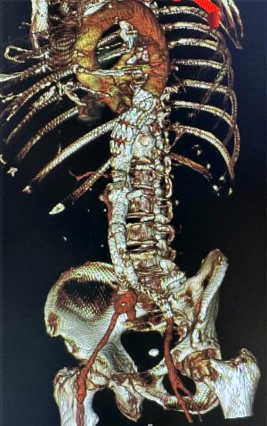 Viterbo - Belcolle - Il workshop "Iliac branch endograft"