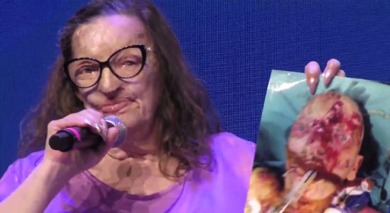 Filomena Lamberti, la donna sfigurata con l'acido