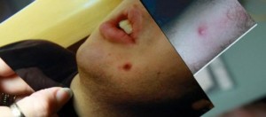 Le bruciature di sigaretta