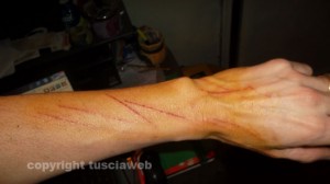 Il braccio tagliato della donna aggredita e rapinata 