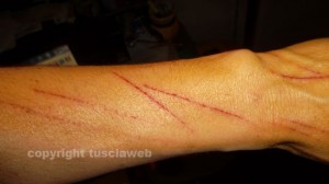 Il braccio tagliato della donna aggredita e rapinata 