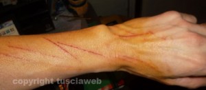 Il braccio tagliato della donna aggredita e rapinata