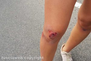 Viterbo - Il ginocchio di una ragazza caduta all'incrocio di strada Pontesodo