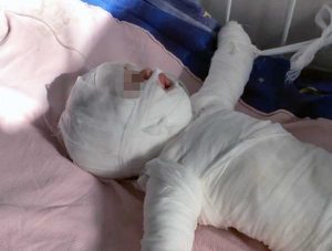 Odessa - Bimba di 11 mesi ustionata