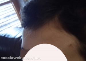 Il segno del colpo subito dal bambino