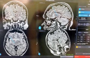 Viterbo - Stimolazione cerebrale contro il Parkinson all'ospedale di Belcolle