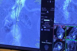 Viterbo - L'intervento di chirurgia vascolare aortica