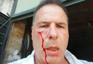 Giampiero Vaselli dopo l'aggressione