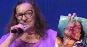 Filomena Lamberti, la donna sfigurata con l'acido