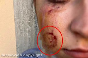 Morsa in discoteca da una "rivale" la denuncia