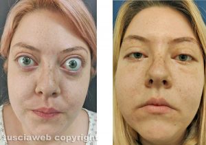 Marika Salza prima e dopo l'intervento