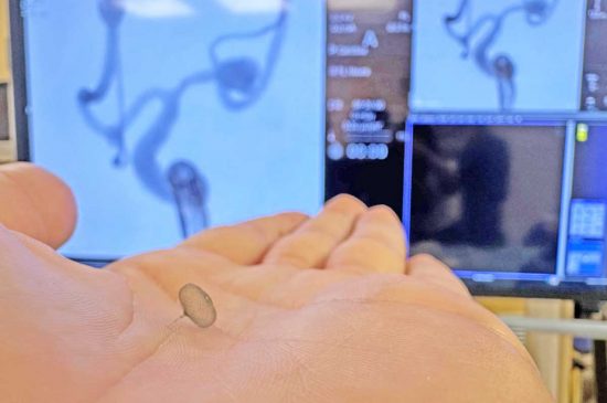 Viterbo - Al Belcolle la prima simulazione del trattamento di aneurismi cerebrali con stampa 3d e realtà aumentata