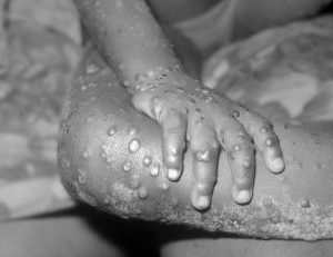 Vaiolo delle scimmie