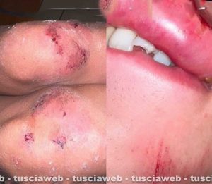 Le immagini delle conseguenze dell'aggressione denunciata da Giul