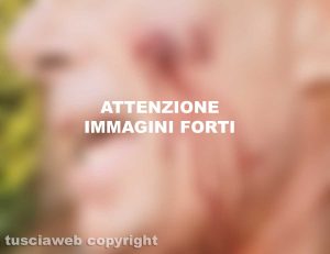 Vetralla - Alcune delle ferite riportate da Marco Antonioli