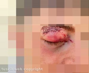 Aggressione in discoteca - Le ferite sul volto della vittima