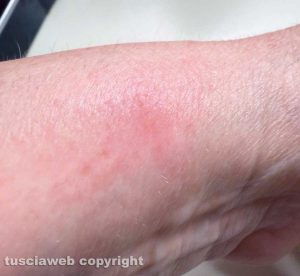 Una puntura di zanzara