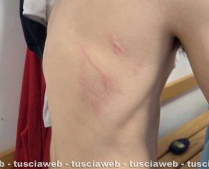 Calci e pugni in faccia ai giocatori - La denuncia affidata ai social da Riccardo Giovannini, allenatore delle giovanili della Sorianese - Le lesioni riportate